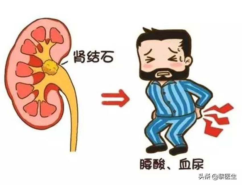 查出肾结石但是没感觉,查出肾结石腰不舒服需要碎石吗