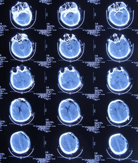 颅脑外伤术后脑积水,脑外伤脑积水颅骨缺失