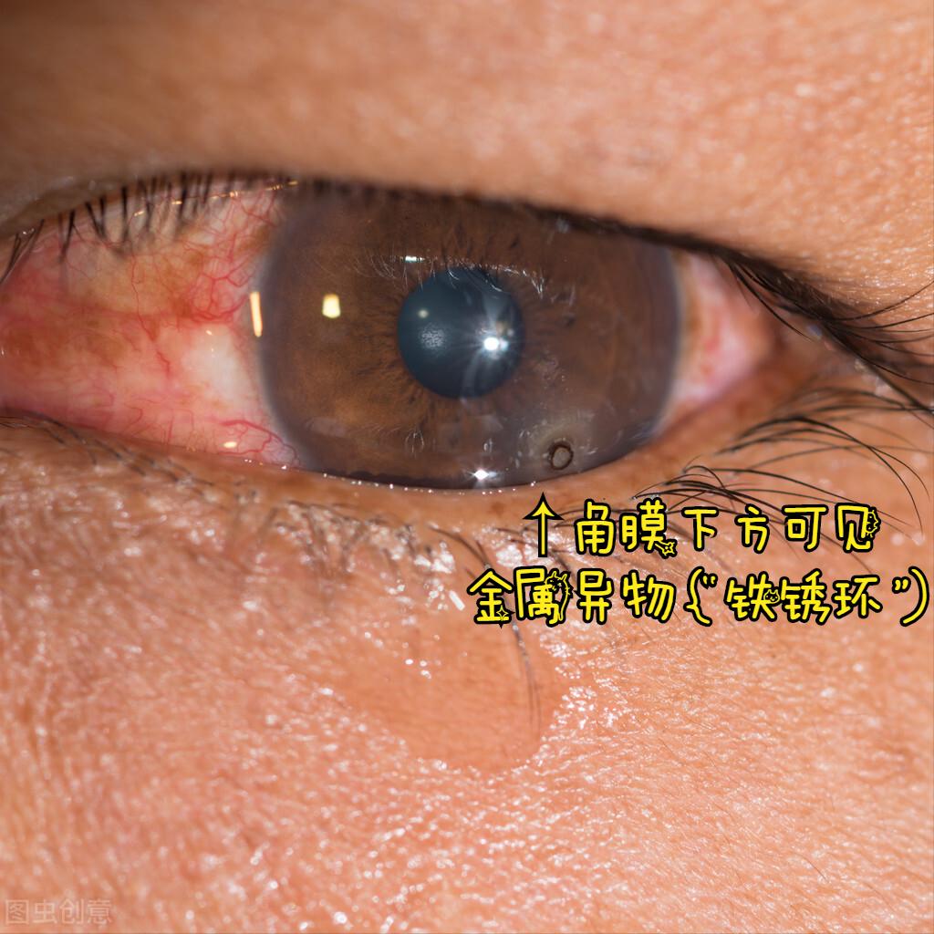 角膜深层异物有后遗症吗,角膜有异物是什么症状