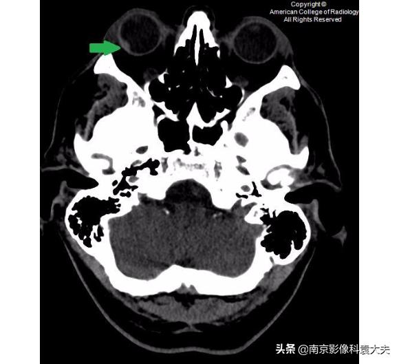 22岁男子眼睛意外失明,中年男子突然右眼失明半小时