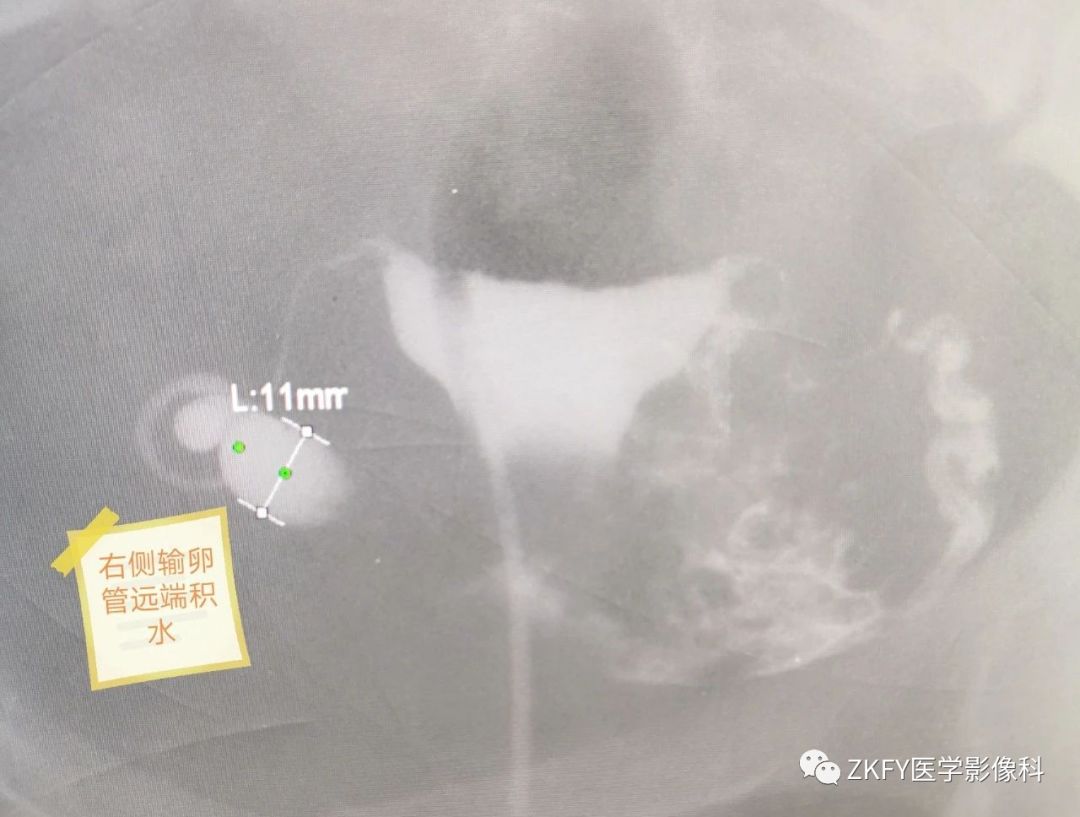 子宫输卵管造影术,子宫输卵管造影术包括哪些项目