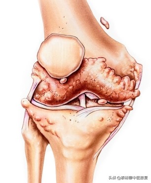 膝关节增生疼痛偏方,四神煎治膝关节疼痛