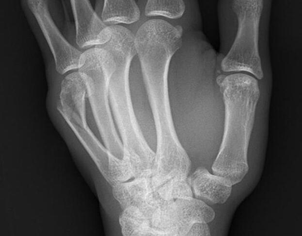 拳击手骨折手背凸起,了解什么是拳击手骨折