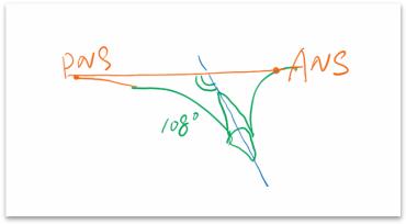 骨性龅牙和牙性龅牙的区别,牙性龅牙和骨性龅牙怎么矫正
