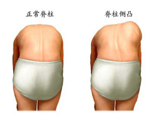 特发性脊柱侧凸的康复治疗方法,先天性脊柱侧凸