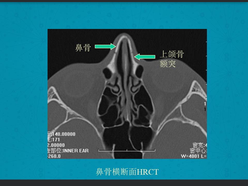鼻骨骨折复位全过程,诊断证明鼻骨骨折问号是什么意思