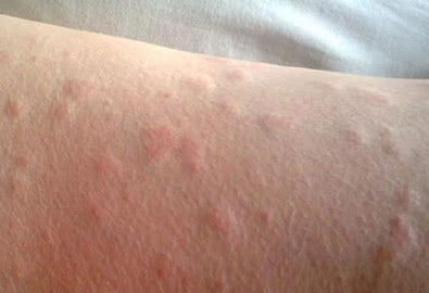 麻疹有哪些症状荨麻疹是啥样的,麻疹和荨麻疹的区别在哪里