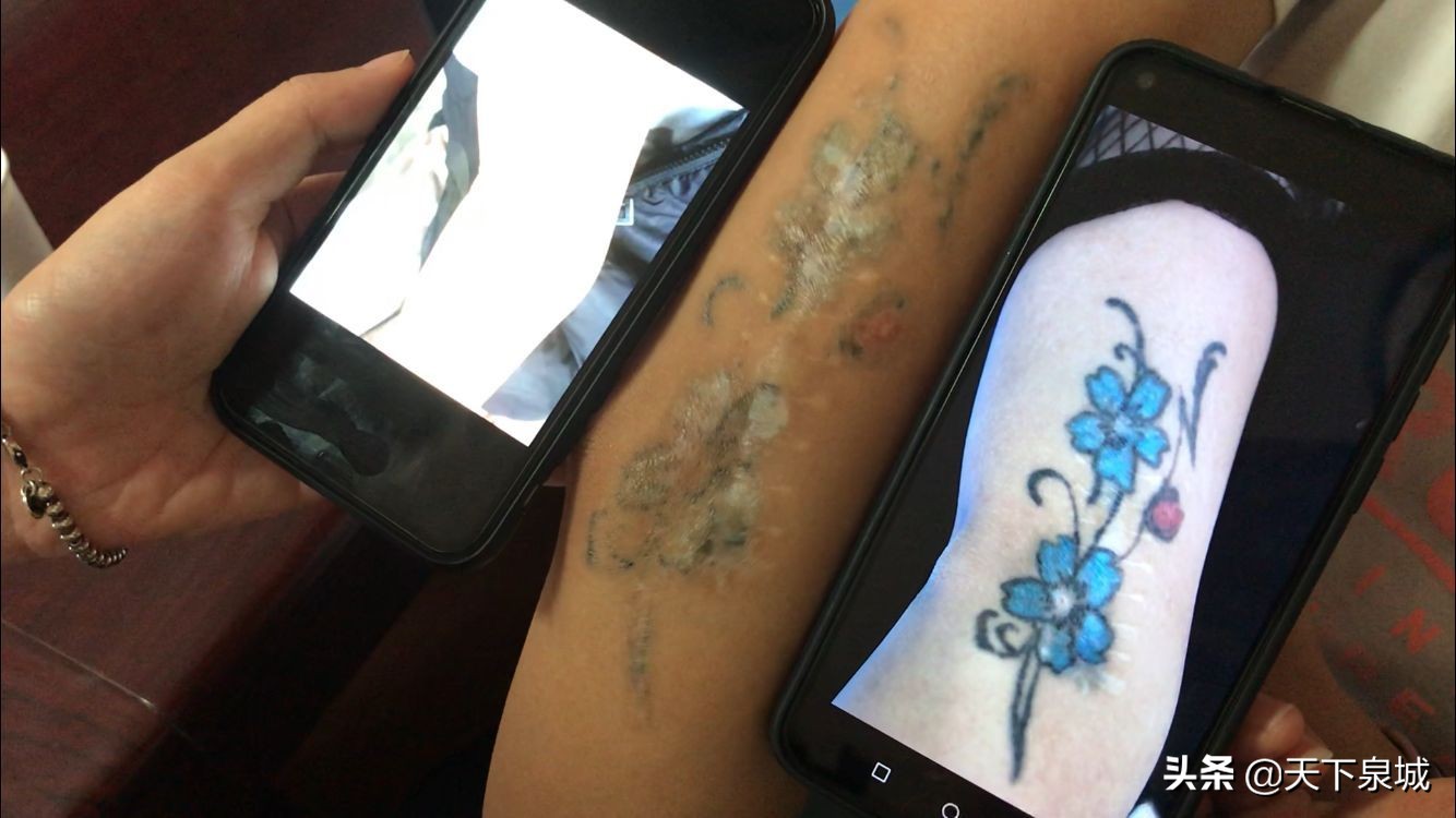 济南华夏医院洗纹身效果怎么样,济南华夏医院洗纹身怎么样