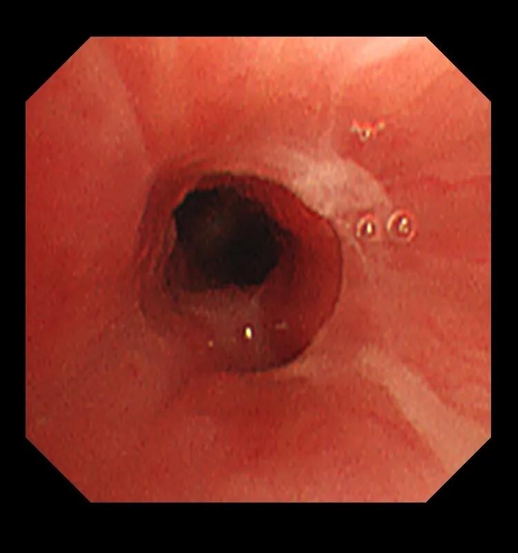 肺炎治不好会怎么样,肺炎治不好怎么办