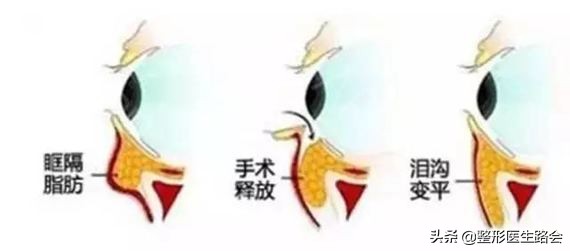 填了泪沟眼睛淤青很厉害,填完泪沟8个月了还淤青怎么办