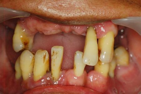 缺的牙齿长期不种牙会怎么样,牙病一直拖着不治会得什么病