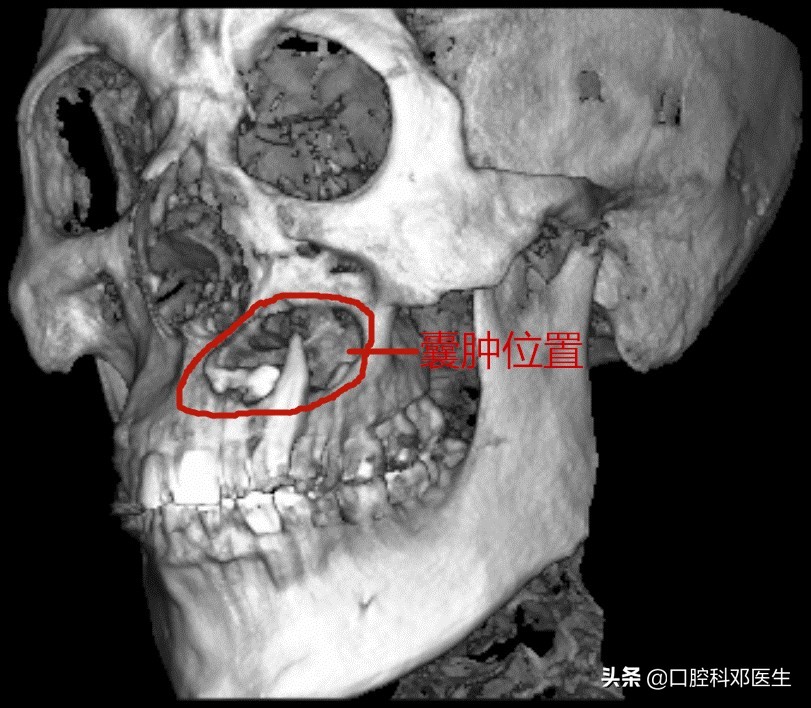 水平阻生埋伏牙真实拔除过程,埋伏阻生牙一辈子不拔行吗