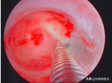 宫腔粘连合并妊娠,宫腔粘连容易导致生化妊娠吗