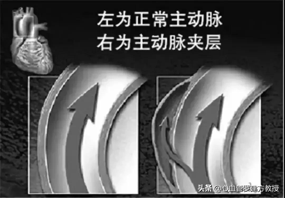 突发胸背痛，不到一天就死亡...警惕这个主动脉疾病