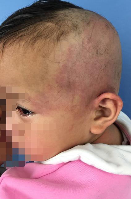 代涛博士的痣长在哪里,代涛博士鲜红斑痣