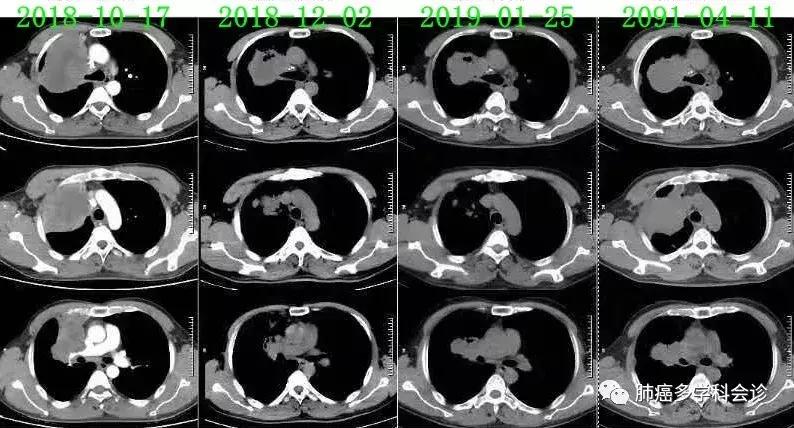上海专家肿瘤治疗新探索,肿瘤诊疗一体化治疗方案