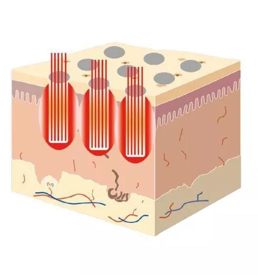 点阵激光祛痘印的副作用和危害,做点阵激光手术有什么危害