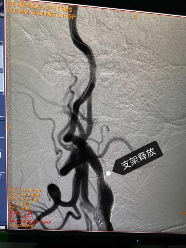 取栓急诊手术,急救92岁老人取栓成功创奇迹