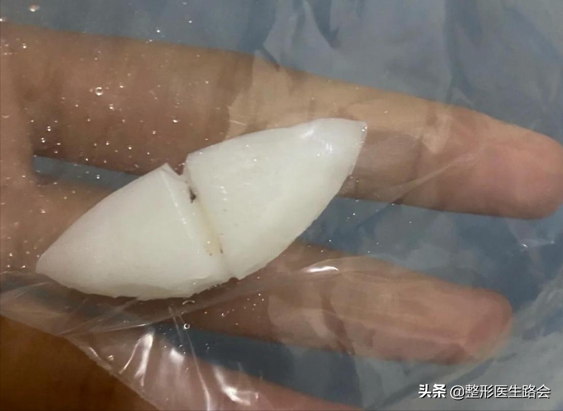 做假体下巴的真实案例,做假体下巴后的真实感受