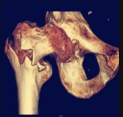 老年人骨质疏松严重造成腰骨折,髋部骨折包括哪些骨折