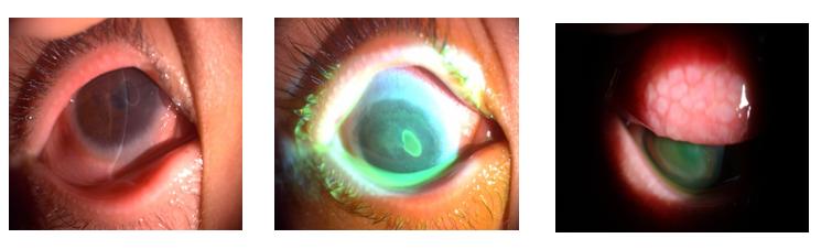 过敏性结膜炎眨眼睛很严重,眼角奇痒无比是角膜炎还是结膜炎