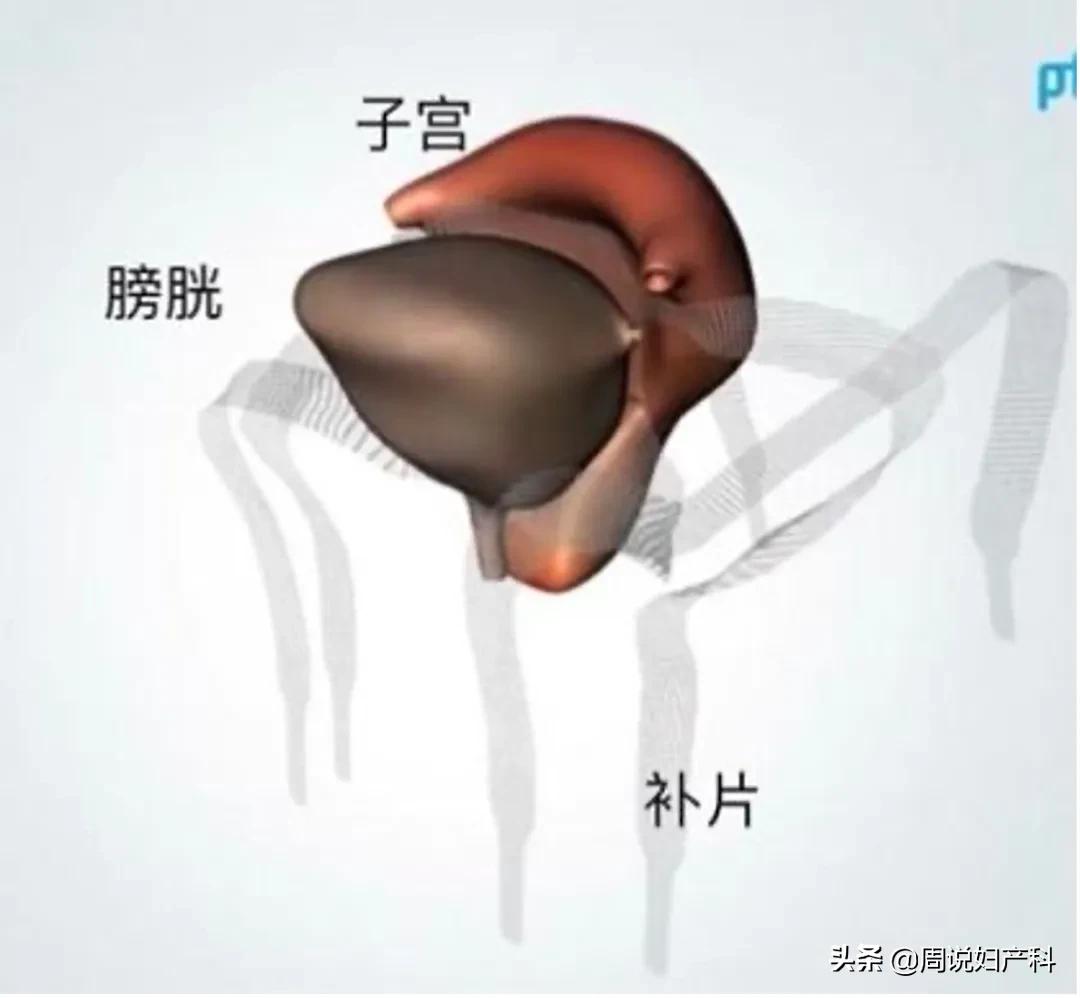 生完孩子后憋不住尿,生完孩子憋不住尿怎么办