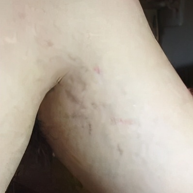 医生推荐防妊娠纹,搞定妊娠纹几十块钱就够了