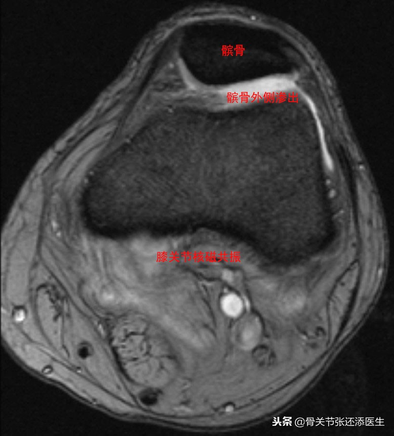 髌骨痛不能弯曲怎么办,髌骨不疼但脱位了怎么治