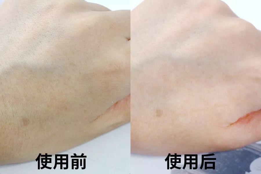 冬天手脚裂口,手脚冬天裂口怎么治疗