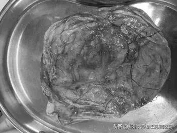 妇产科完成一例经脐单孔腹腔镜下巨大盆腔包块切除术