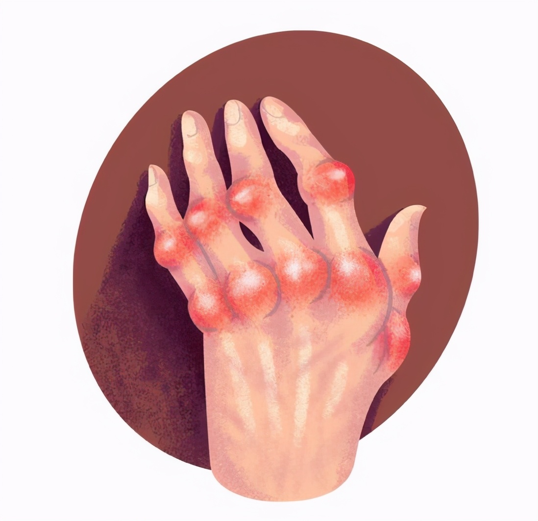 痛风的基础知识及用药,痛风各期用药攻略