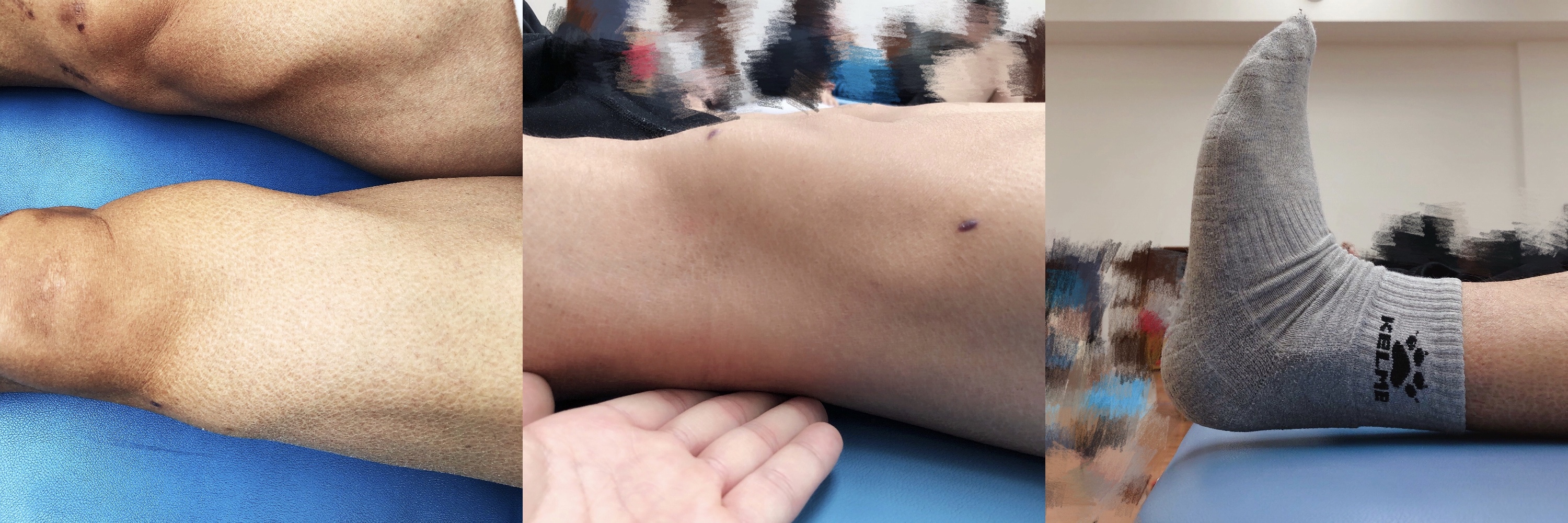 康复训练直抬腿的正确训练方法,直腿康复训练