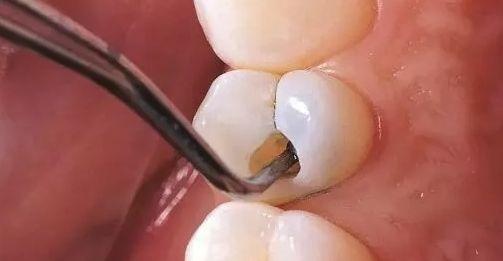 大连齿医生口腔科普,口腔科普大连做补牙一般要多少钱