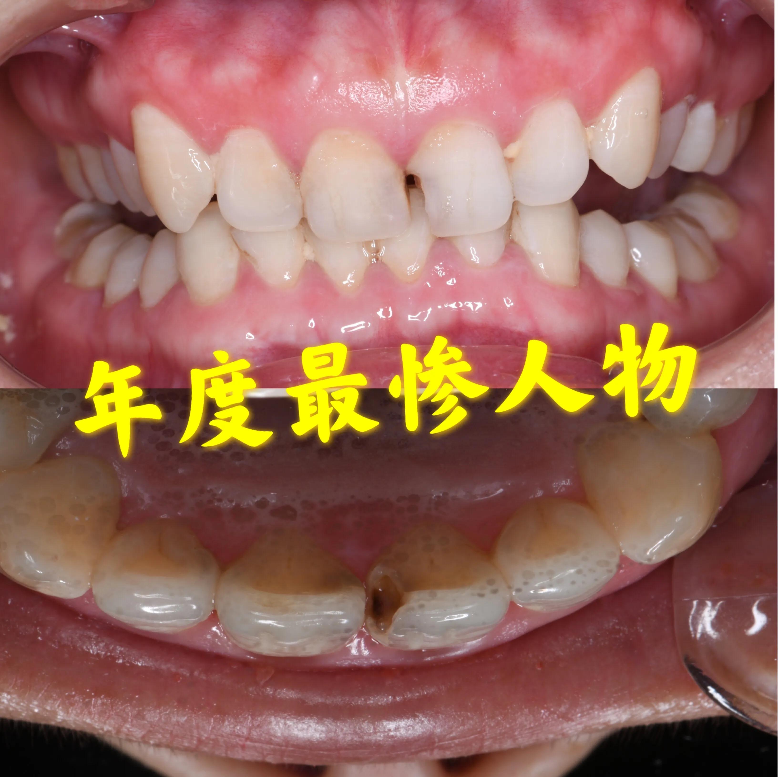 断牙修复,断牙修复病历