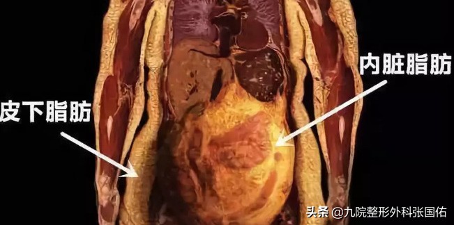 肥胖型大肚子的表现,肥胖大肚子是怎么引起的