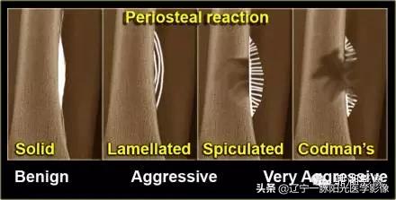 骨膜反应类型有哪几种,骨膜反应怎么快速恢复