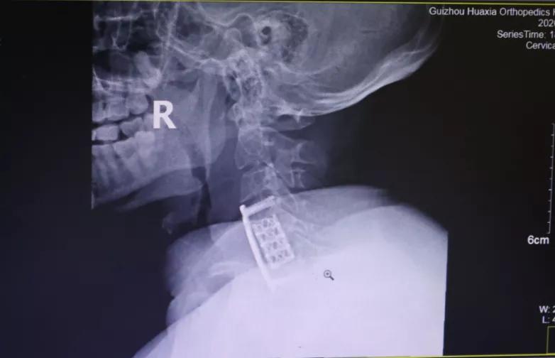 手痛手麻手指无力真相竟是颈椎病,颈椎病手麻手指有针刺感