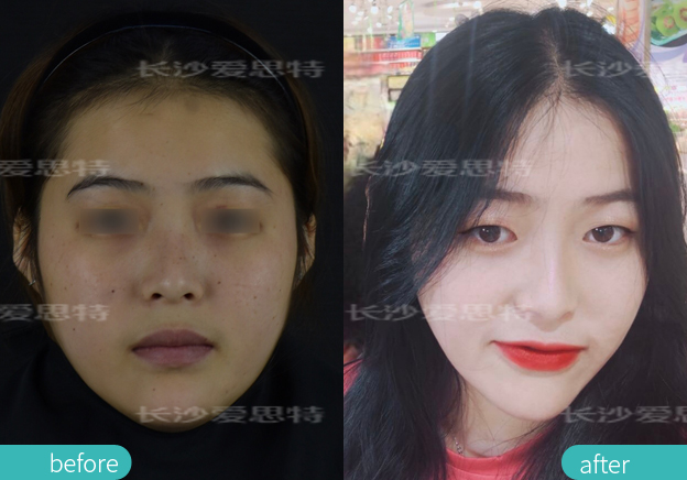 面部雀斑挂哪个科,皮秒嫩肤雀斑