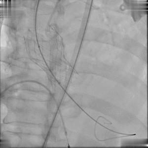 BAV遭遇心脏突然停跳，Sapien3快速植入挽救患者生命