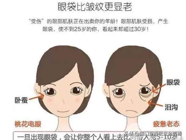 医美去除眼袋多少钱,眼袋皱纹怎么去除医美