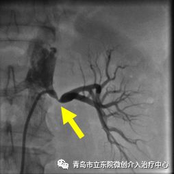 讲述一位高血压患者治愈经历,难治性高血压诊治图解