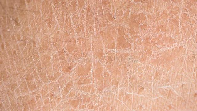 冬天裤子上很多白色皮屑怎么去除,冬天腿上干燥起白皮屑