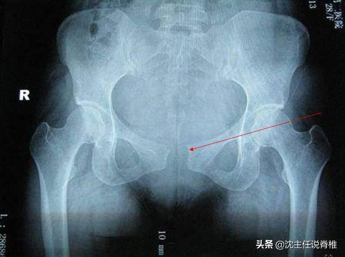 产后耻骨痛如何缓解,产后妈妈胯骨疼痛