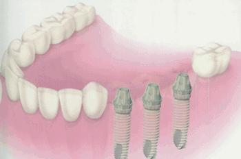 不是我吓你，掉1颗牙不管，周边3颗牙要遭殃