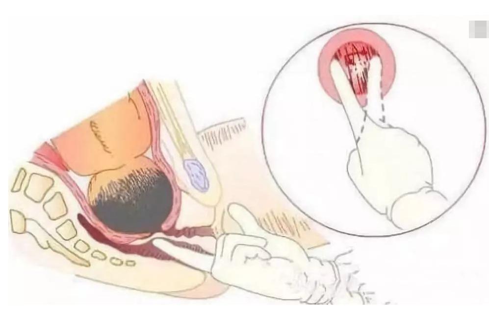 知道了内检细节后，丈夫反应自私又无知，孕晚期内检注意3方面