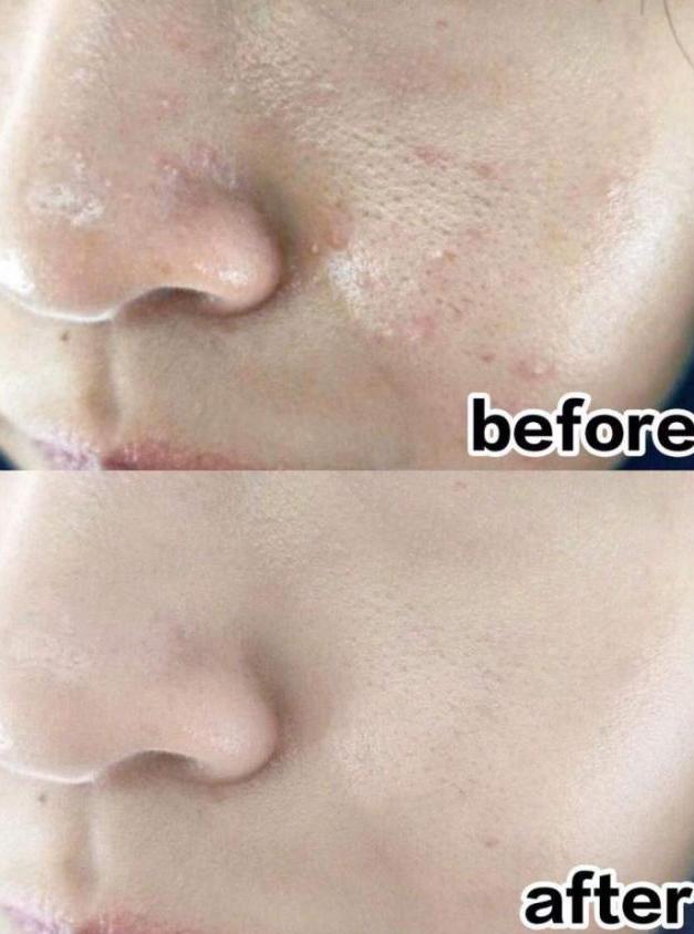 闭口反反复复长到底怎样才能根治,闭口反反复复长怎么办