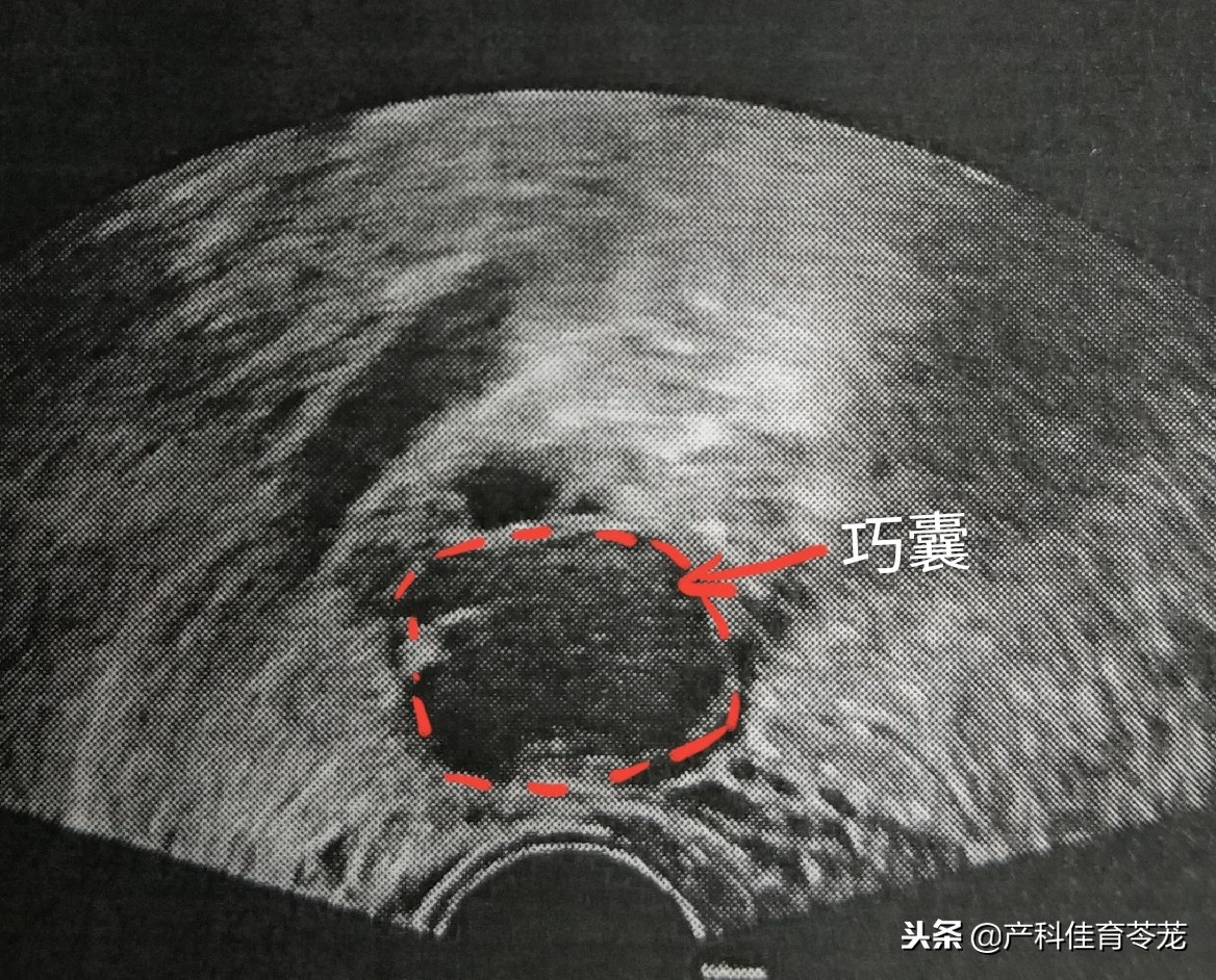 卵巢囊肿做了肿瘤标志物显示正常,卵巢囊肿内见密集光点正常吗