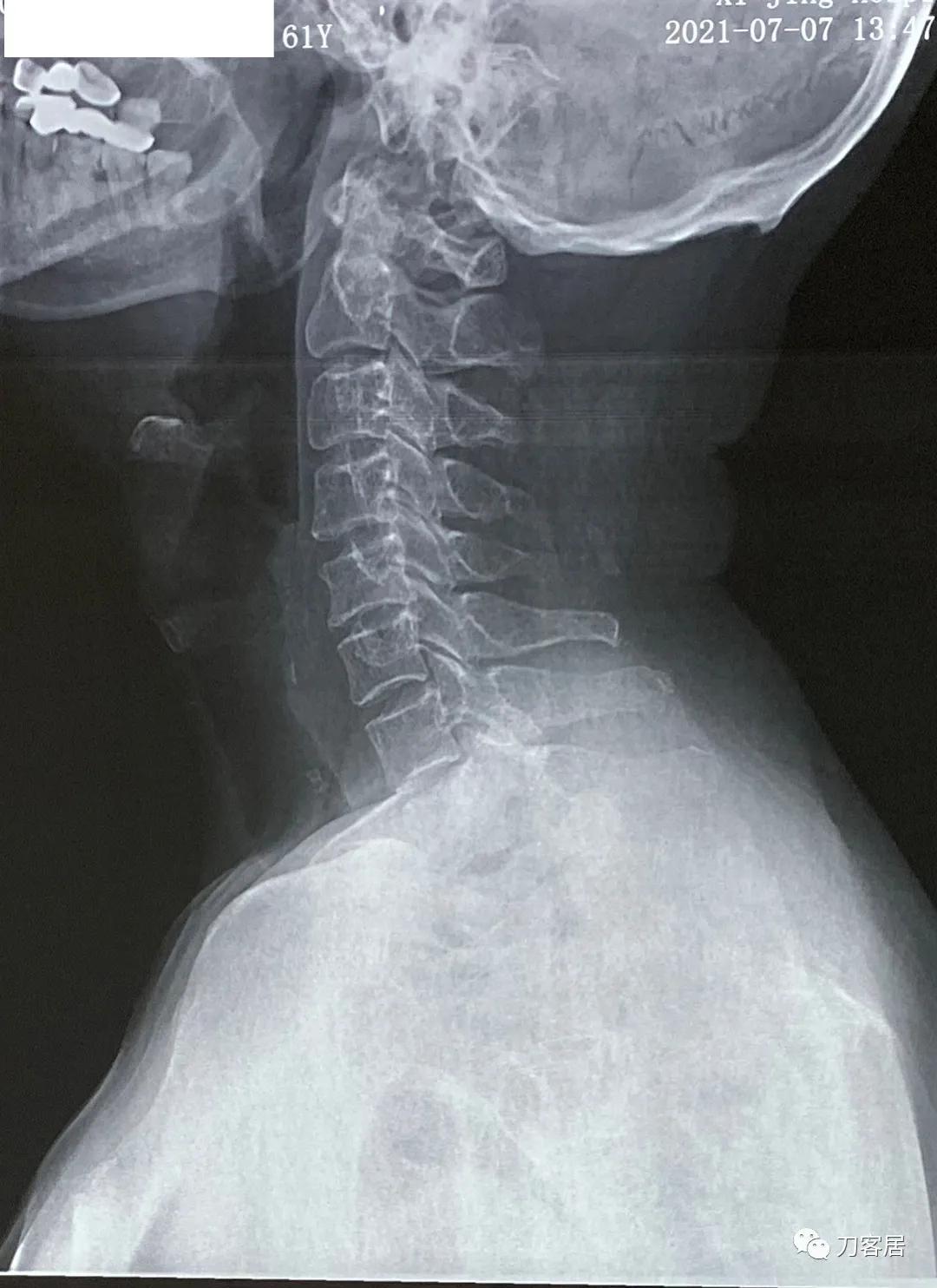 病例左侧躯体麻木,右侧肢体麻木典型病例