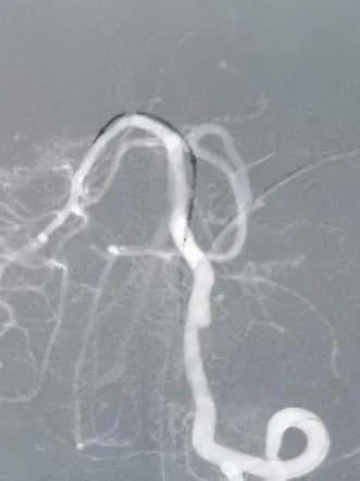 淄博市中心医院治疗动脉瘤,tubridge动脉瘤支架医保报销多少