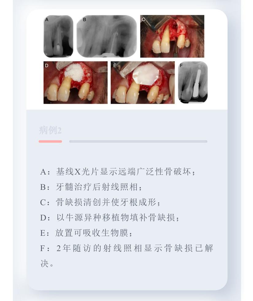 牙周病引起的牙髓病变的治疗原则,牙周组织可以修复再生吗